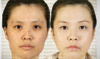 光子祛斑多少钱一次